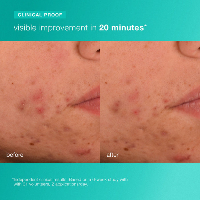acne biotic moisturizer clinical proof