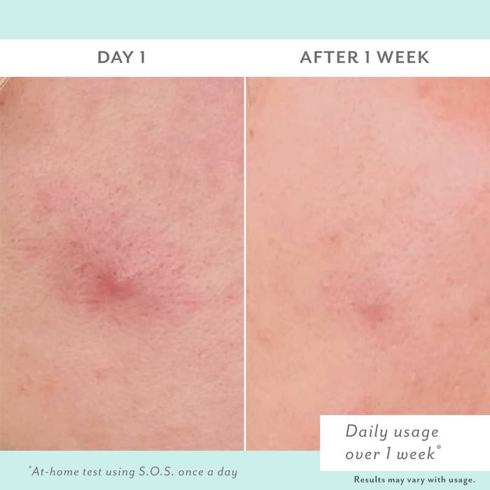 Before and after comparison of skin treatment on Day 1 and After 1 Week.
