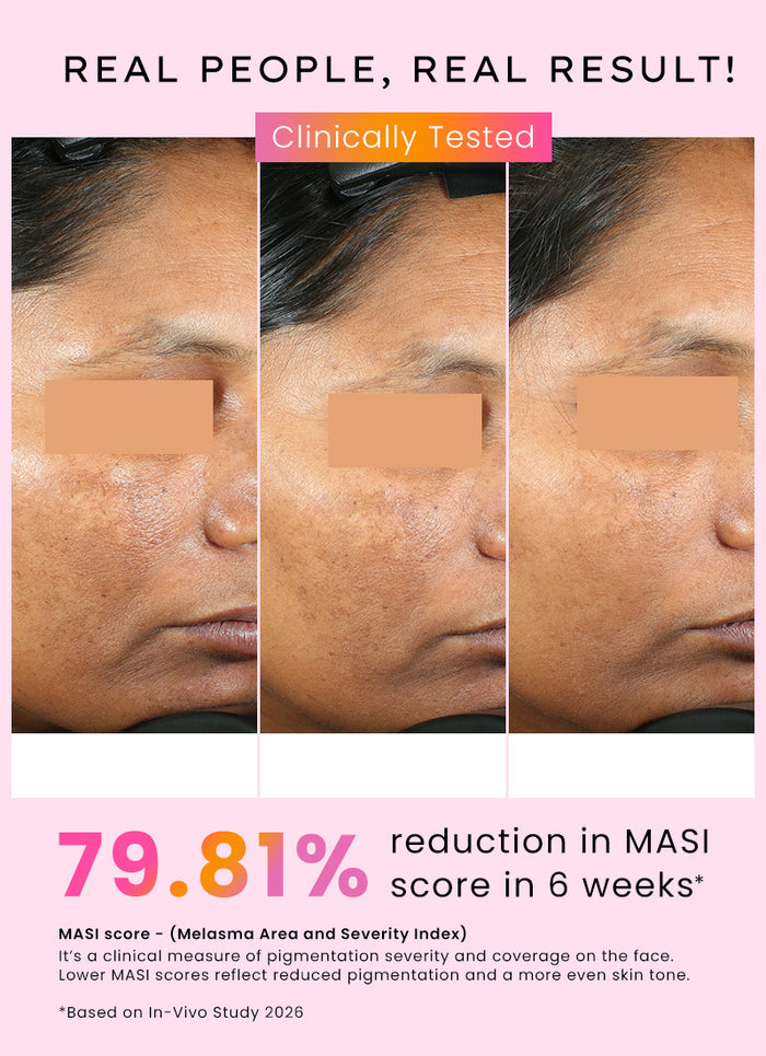 Hyphen Dual Phase Advanced De-Pigmentation Serum 30ml - clinically tested before and after, 79.81% MASI reduction