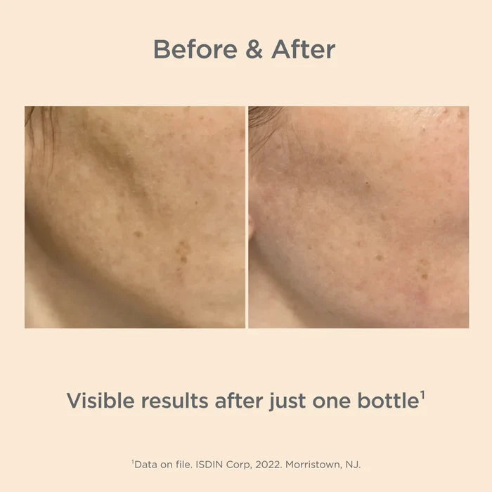 Before-and-after cheek with dark spots reduced after one bottle of ISDIN Melaclear Advanced
