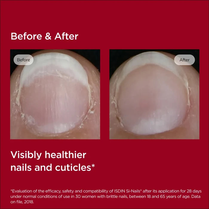 Before and after brittle nail results with healthier nails and cuticles, ISDIN Si-Nails