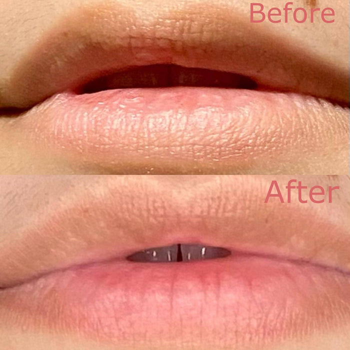 Before-and-after close-up of lips showing improved smoothness and hydration after treatment